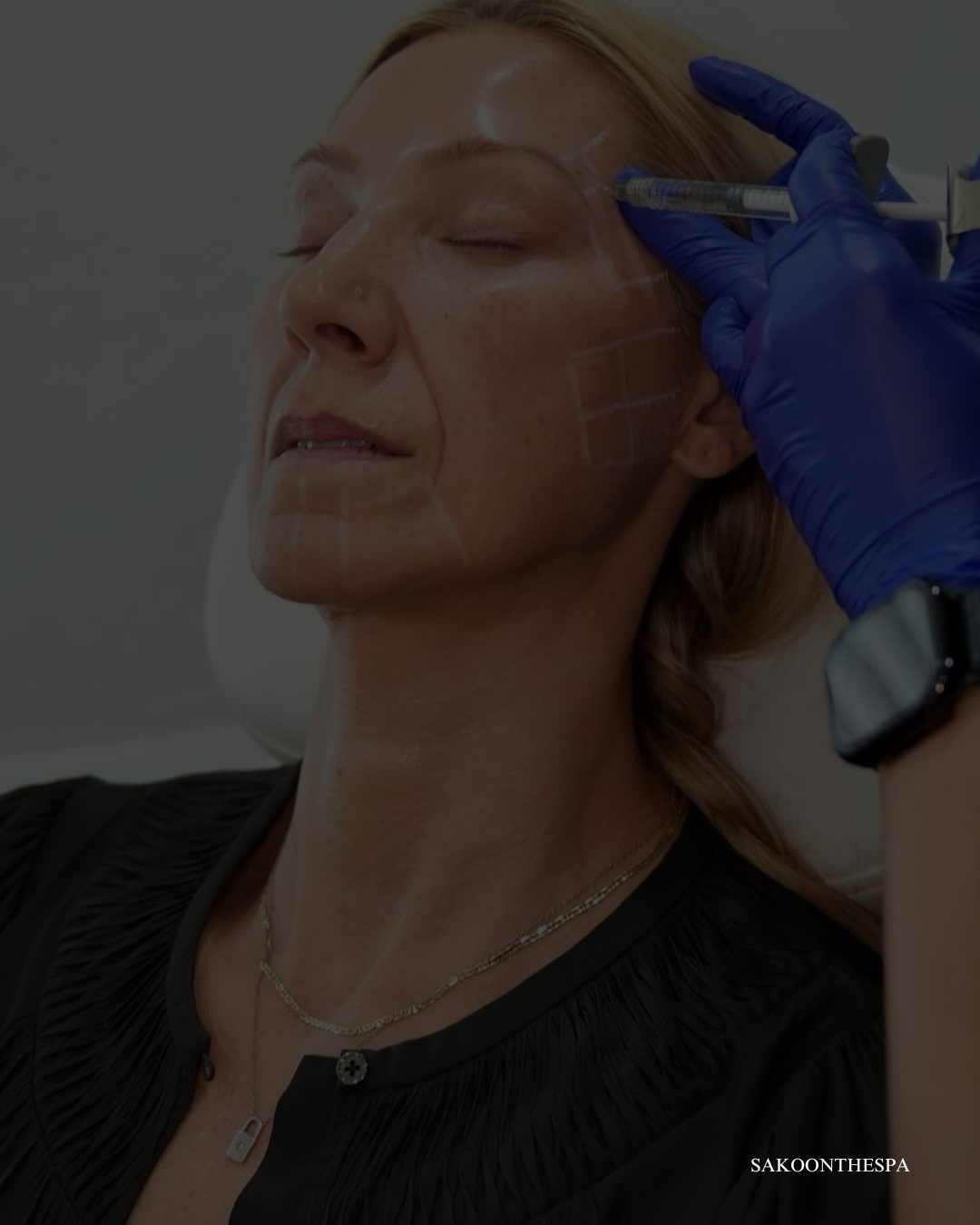 Mid-Face Filler- July Special
